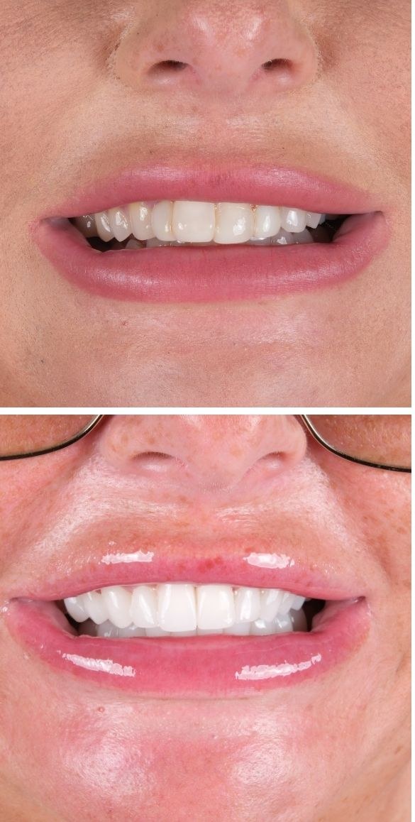 Cropped close up of the teeth before and after dental treatment at Seçil Dental Clinic, example 1