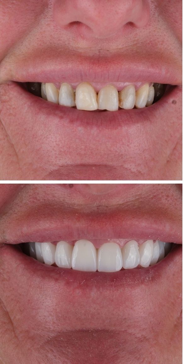 Cropped close up of the teeth before and after dental treatment at Seçil Dental Clinic, example 10