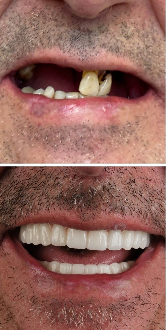 Cropped close up of the teeth before and after dental treatment at Seçil Dental Clinic, example 11