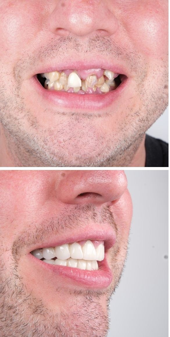Cropped close up of the teeth before and after dental treatment at Seçil Dental Clinic, example 12