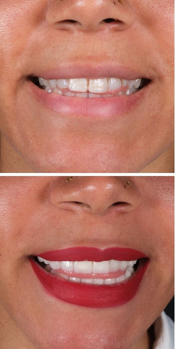 Cropped close up of the teeth before and after dental treatment at Seçil Dental Clinic, example 2