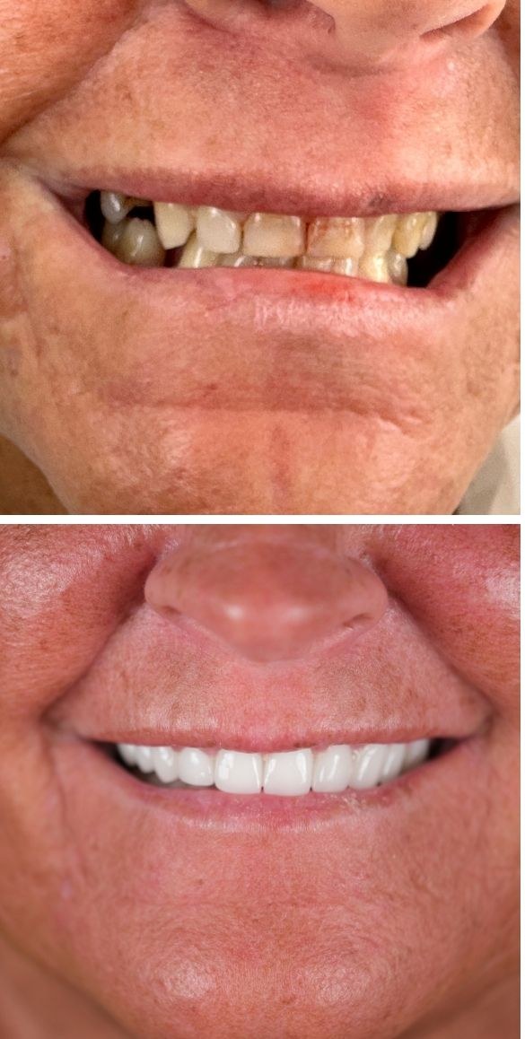 Cropped close up of the teeth before and after dental treatment at Seçil Dental Clinic, example 3