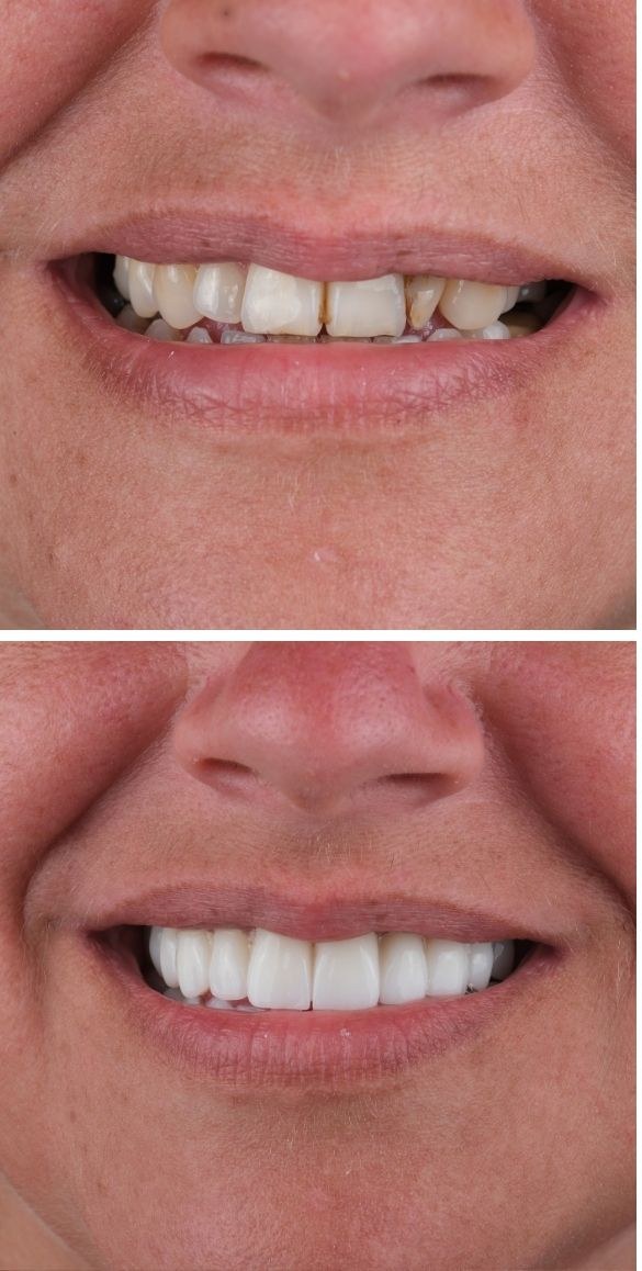 Cropped close up of the teeth before and after dental treatment at Seçil Dental Clinic, example 4