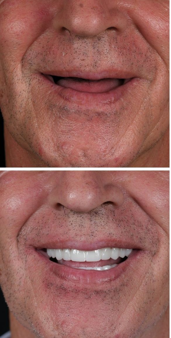 Cropped close up of the teeth before and after dental treatment at Seçil Dental Clinic, example 5