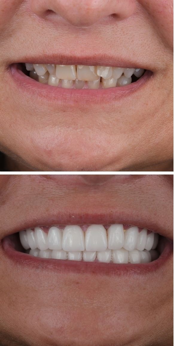 Cropped close up of the teeth before and after dental treatment at Seçil Dental Clinic, example 6