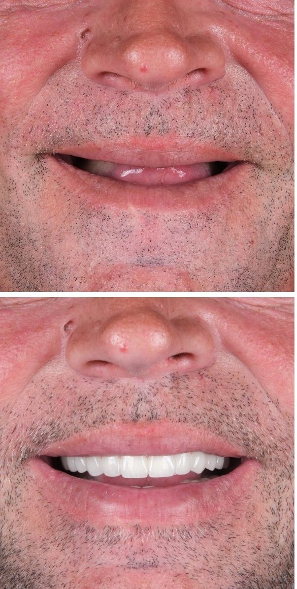 Cropped close up of the teeth before and after dental treatment at Seçil Dental Clinic, example 7