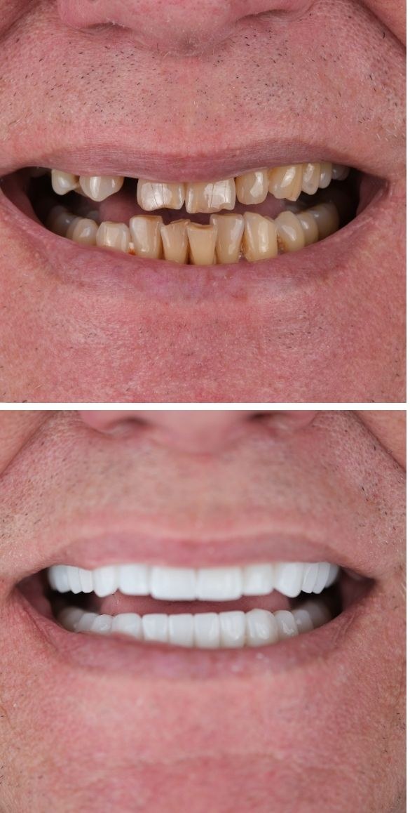 Cropped close up of the teeth before and after dental treatment at Seçil Dental Clinic, example 8