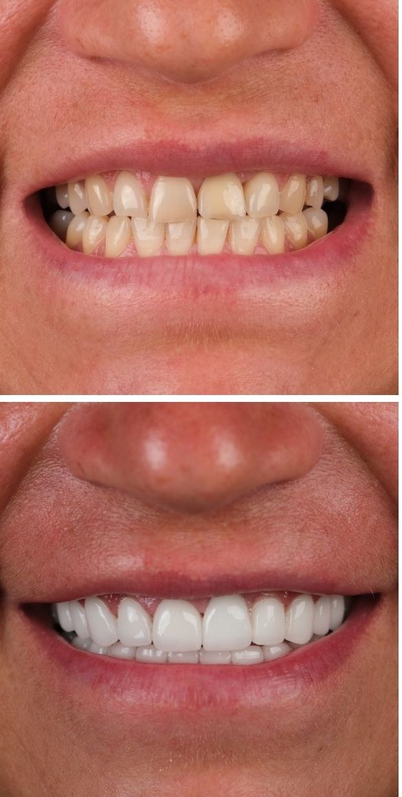 Cropped close up of the teeth before and after dental treatment at Seçil Dental Clinic, example 9