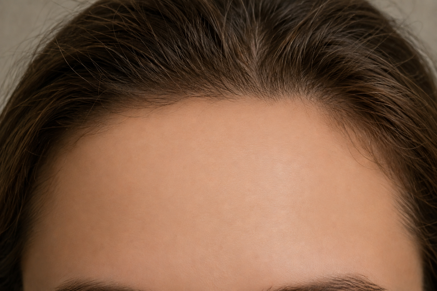 Anti Wrinkle Treatment — after